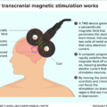Medication-Resistant Major Depressive Disorder (MDD) and Transcranial Magnetic Stimulation (TMS) for